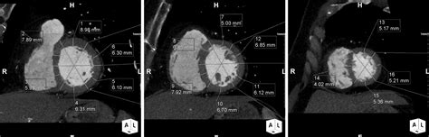 left ventricular wall thickness measurement ct|left ventricular wall thickness measurement.